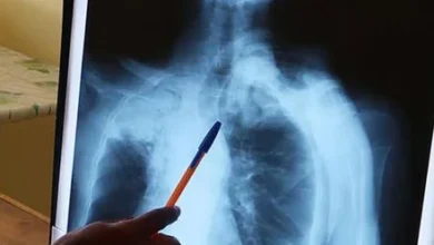 Photo of 4 mil casos de tuberculosis